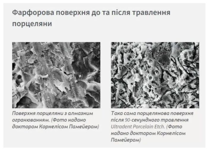 Porcelain Etch (Порцелян Эйч), 1.2мл - Для реставрации сколов керамики (Ultradent)